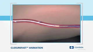 Radiofrequency Ablation Animation