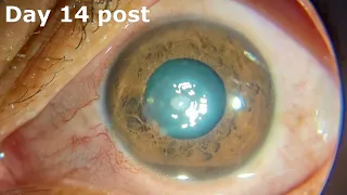 Surgical aspect of treating a corneal ulcer