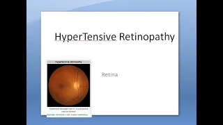 Ophthalmology 282 a Hypertensive Retinopathy HyperTension High Blood Pressure Eye Effect DisOrder