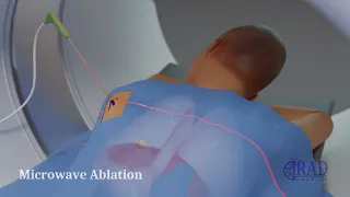 Lung Tumor Ablation (Microwave vs. Cryoablation)