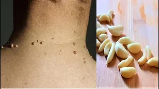Remove Skin Tags | Home Remedies To Remove Skin Tags Easily