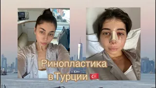 Ринопластика в Турции. Мой опыт. Чуть не отменили операцию 🫣