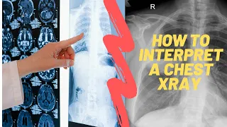 How to read a Chest Xray?. For medical students, residents and clinicians.