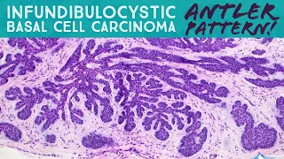 Infundibulocystic Basal Cell Carcinoma (BCC w/ follicular differentiation): Dermpath in 5 Minutes