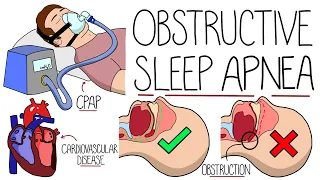 Understanding Obstructive Sleep Apnea Syndrome