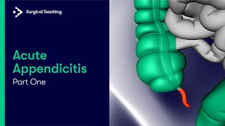 Acute Appendicitis Part 1| What is it and What's the Important Anatomy?