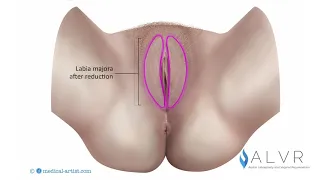 Labia Majora Reduction Animation - Underside View