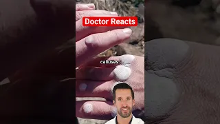 ER Doctor REACTS to World's Largest Hand Callus