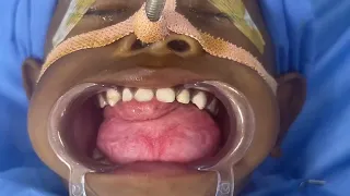 Huge Ranula or Mucous Retention Cyst under the Tongue Removed by Fine Facial Plastic Surgery