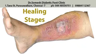 #Cellulitis Infection healing stages
