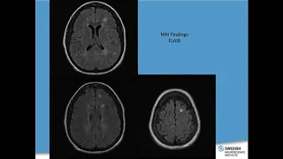 MS 101 - James Bowen, MD - October 2018