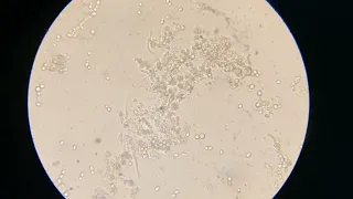 Candida (hyphi and spores) in urine, GUE test.