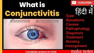 Conjunctivitis (pink Eye)- viruses, bacteria, Allergens,erritant exposure | In Hindi ||