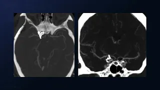 Pterional Craniotomy for Clipping of a Posterior Communicating Artery Aneurysm