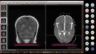 17.Neuroimaging Case Discussion by Professor Aida Youssef &spot cases by Professor Hesham Elsheikh