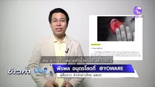 ชัวร์ก่อนแชร์ : 10 วิธีแก้หูอื้อเบื้องต้นใช้ได้จริงหรือ?