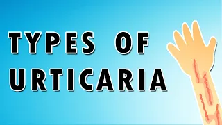 Urticaria Symptoms, Treatment, and Causes