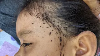 How to get rid all of head lice - Remove thousand lice from hair