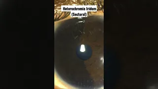 Heterochromia Iridum(Sectoral)