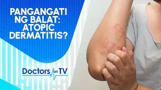 ALAMIN SA DOTV: Sakit sa balat o Atopic Dermatitis ano nga ba ang sanhi?