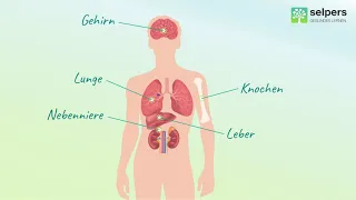 Lungenkrebs - Symptome (Experte erklärt)
