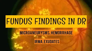 DIABETIC RETINOPATHY clinical findings || Microaneurysms, hemorrhage, irma,  hardexudates and more..