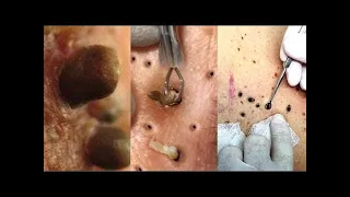 SATISFYING Pimple Popping and Blackheads Removal Compilation #acne #popping #newvideo