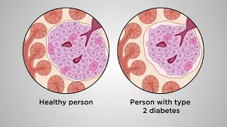 Beyond glucose: A beta-cell centric approach to prevent type 2 diabetes