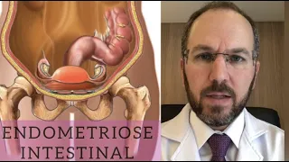 ENDOMETRIOSE INTESTINAL SINTOMAS.