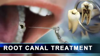 Root Canal Treatment step by step |  Curveia Dental Animation in 3D - Endodontics for tooth decay