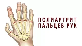 Что нужно знать о полиартрите пальцев рук