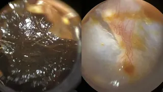 161 - Dark Coloured Ear Wax Removed using the WAXscope®️