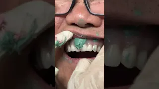 Refitting and Relining Process #Dentures #dental #teeth #smile #lsk121shorts #shortvideo #newvideo