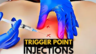 The Anatomy of Pain Relief: A Look at Trigger Point Injections