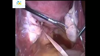 Lap Encerclage and Hysterescopic Septal Resection by Dr Nikita Trehan Sunrise Hospital