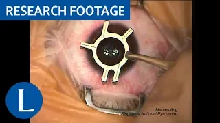 Surgical video: Femtosecond LASIK procedure. Video 1 of 2