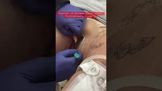 Reveal of Split Scrotum After Urethraplasty (post phalloplasty)