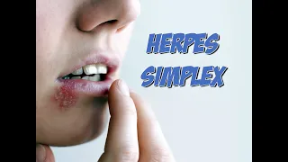 Herpes Simplex