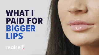 How Much Does Lip Filler and Surgery Cost? 2 Women Share What They Paid