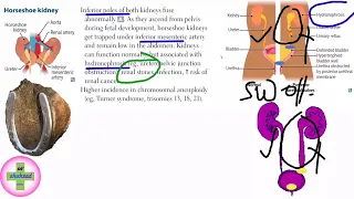 Oligohydramnios usmle ? Horseshoe kidney usmle ? Congenital solitary functioning kidney usmle ? (L2)