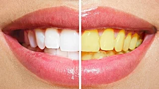 Как Отбелить Зубы в Домашних Условиях