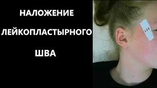 Пластырь для стягивания ран