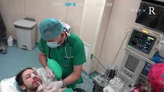 Easy waking up after general anesthesia |Anesthesiologist wakes up patient after rhinoplasty surgery