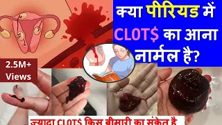 पीरियड में कितना clots आना नार्मल होता है | पीरियड के बाद खून की कमी को कैसे पूरा करे | Home remedy