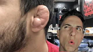 DRAINING MY FRIENDS CAULIFLOWER EAR (TUTORIAL)