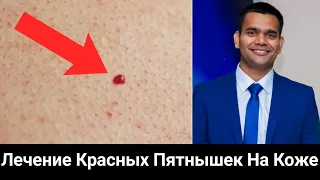 Лечение красных пятнышек на коже.