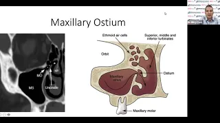 The Digitally Planned Sinus Lift by Dr. Riley Clark