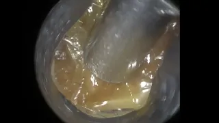 46 - Fully Occluding Sticky Ear Wax Removal with WAXscope®️