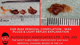 EAR WAX REMOVAL COMPILATION - WAX PLUGS & LIGHT REFLEX EXPLANATION - EP 293