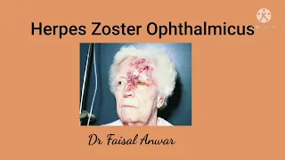 Herpes Zoster Ophthalmicus II Hutchinsons sign II Postherpetic Neuralgia